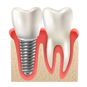 Implante Dentário - Implantes24x